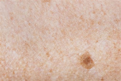 difference between melanoma and age spot